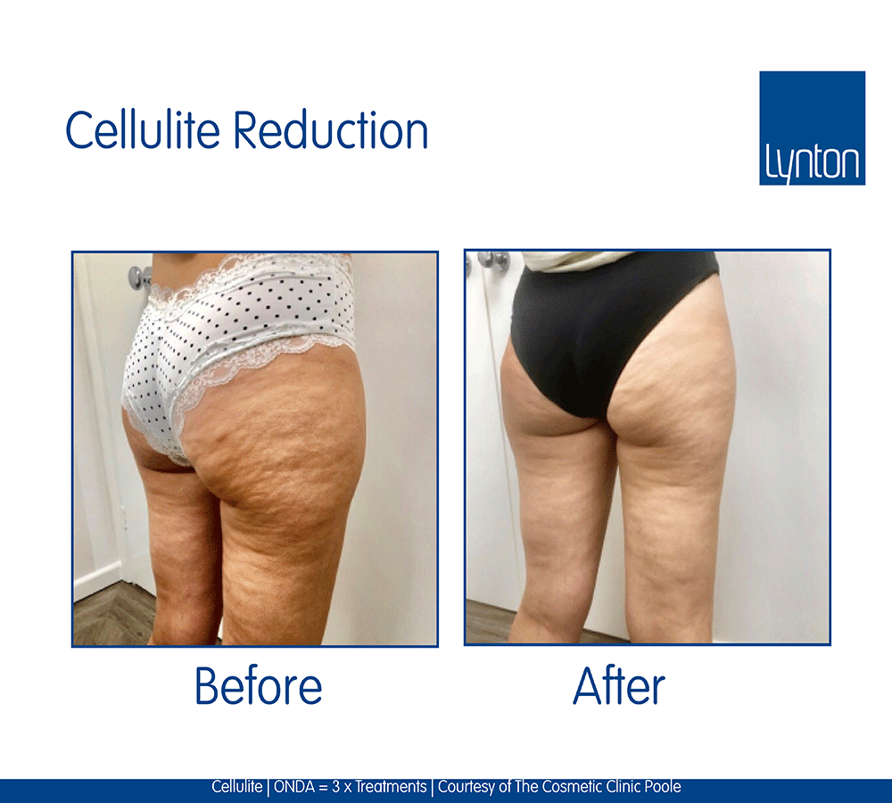 Cellulite Reduction Treatment