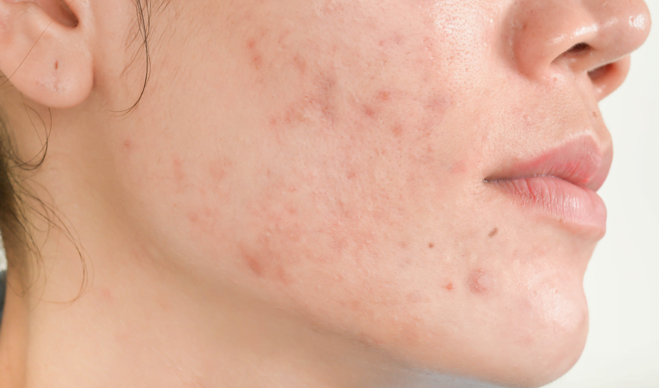 Acne Scar Treatment · Laser Acne Scar Removal · Lynton Clinic, Cheshire