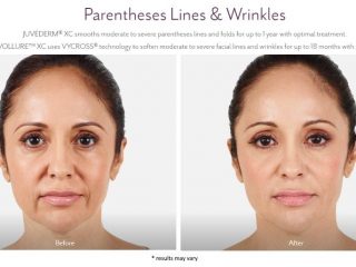 Facial Fillers Before and after images