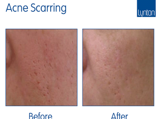 Resurface before and after results