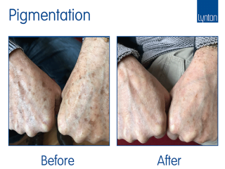IPL Pigmentation treatment Before and After with the Lynton Excelight