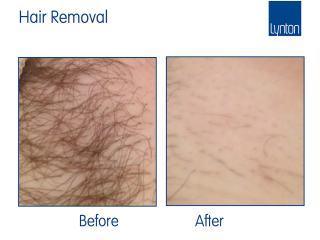 Initia Diode laser hair removal before and after