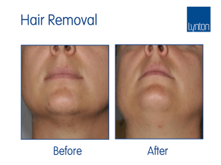 Laser hair removal before and after with the Motus AY