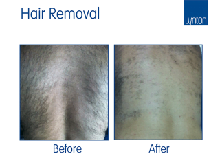 Laser hair removal before and after with the Motus AY