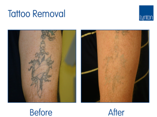 Laser Tattoo Removal Before and After with the Luminette Q