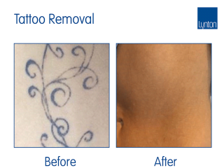 Laser Tattoo Removal Before and After with the Luminette Q