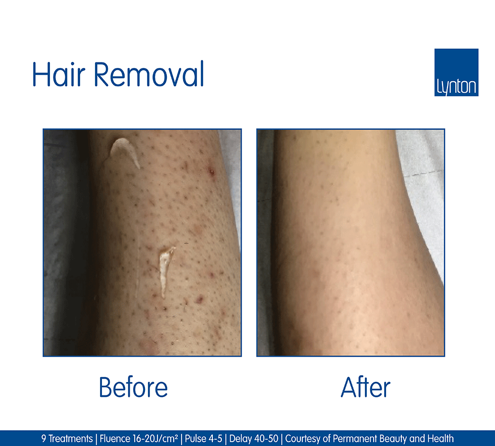 Laser Hair Removal · Professional Treatment · The Lynton Clinic