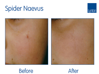 Lumina Laser Treatment Before and After Result