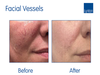 Lumina Laser Treatment Before and After Result