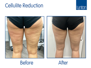 Onda Coolwaves Treatment before and after results for cellulite, fat reduction and skin tightening