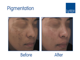 SmartXide CO2 Before and After Results for Laser Skin Resurfacing
