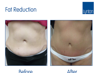 Promax Lipo Treatment before and after results for cellulite, fat reduction and skin tightening