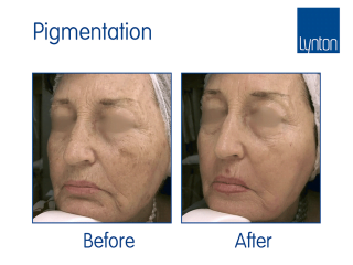SmartXide CO2 Before and After Results for Laser Skin Resurfacing