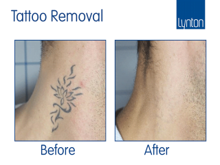 Laser tattoo removal before and after with the Synchro QS4