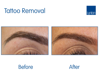 Permanent Eye Brow tattoo removal Before and After