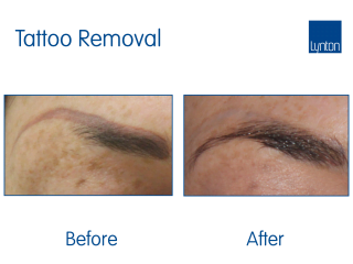 Cosmetic Laser tattoo Removal Before and After