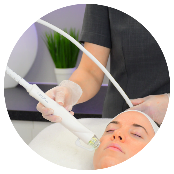 Radiofrequency Microneedling treatment in action