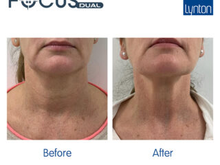 Focus Dual Skin Laxity Before and After
